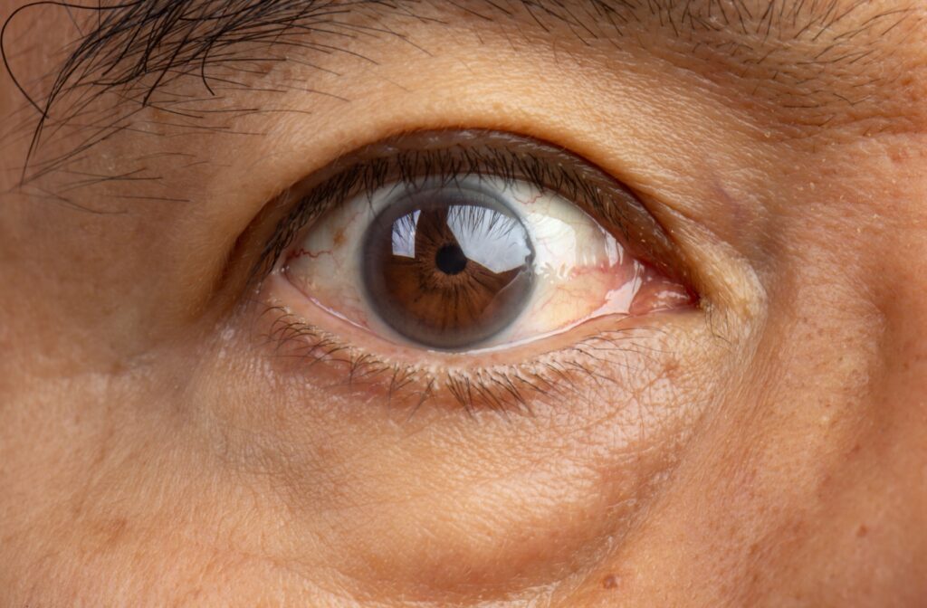 A close-up image of an eye with a cataract developing in it.