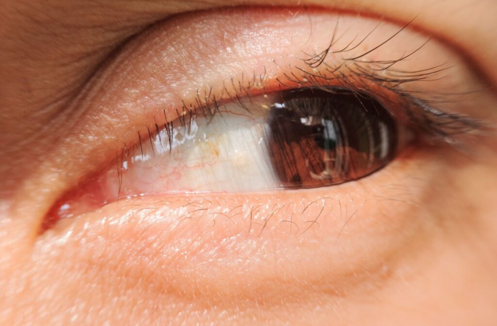 A close-up image of an eye with eyelid inflammation.