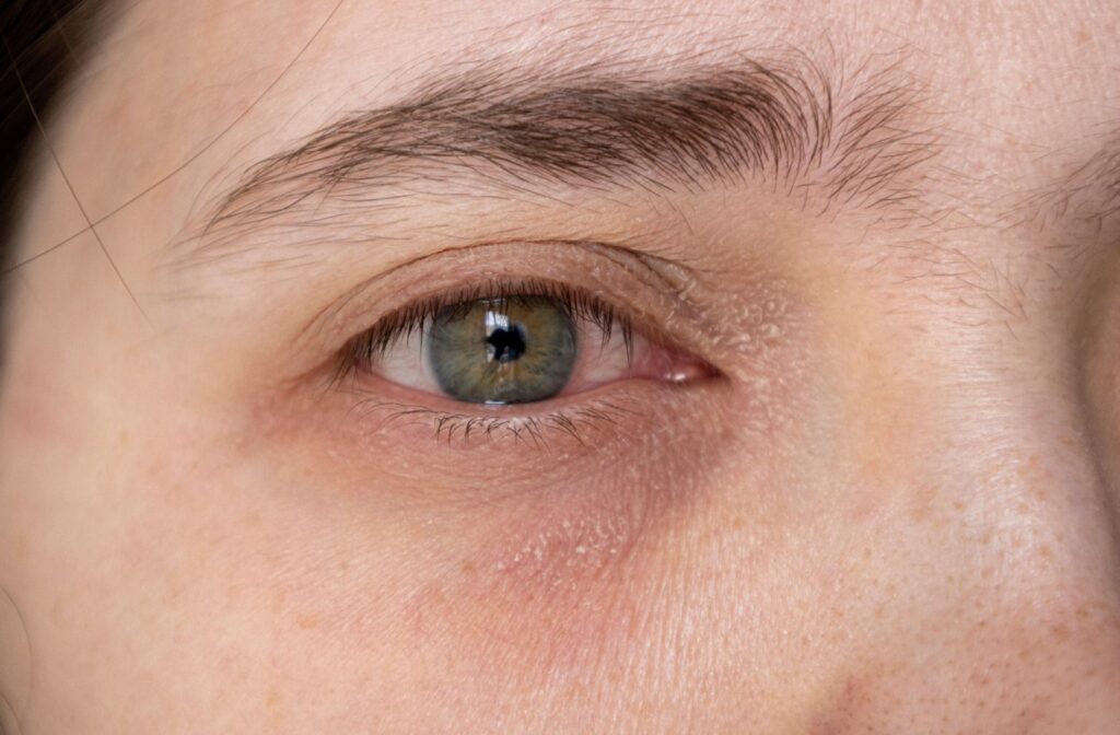 A close up of an irritated, dry eye.